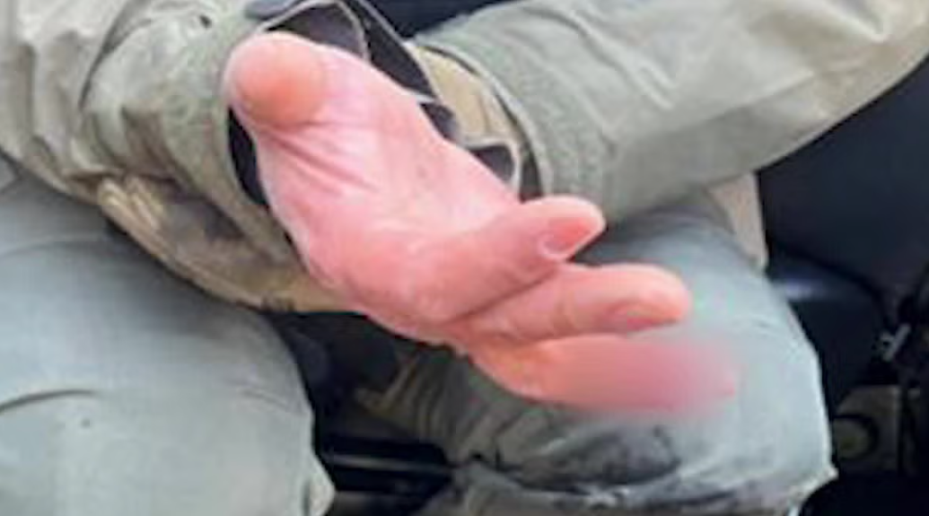 咬断HSI特工手指、骨头外露！疑似华女遭起诉